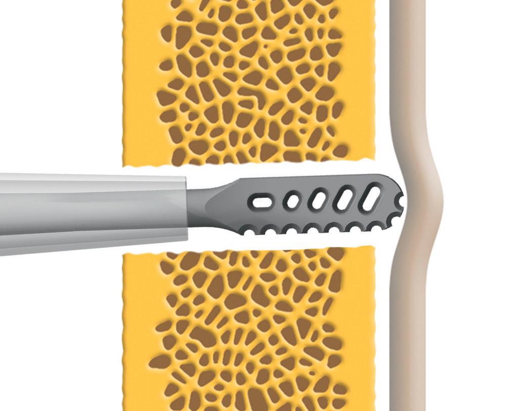 Ultrasonic Bone Instrument